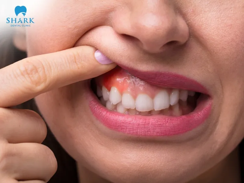 Severe toothache, swollen and red gums are warning signs of a bump on the gum after a root canal