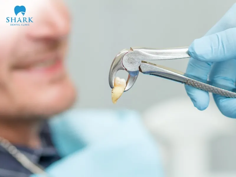 Tooth extraction is considered the last resort when other treatment methods do not bring effective results        