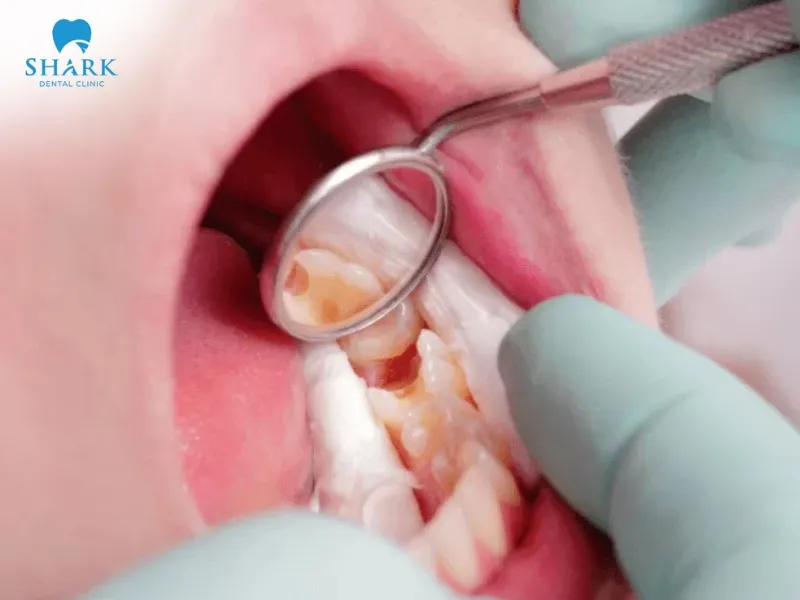 A baby root canal is indicated when the infection has spread extensively and the pulp has lost its function