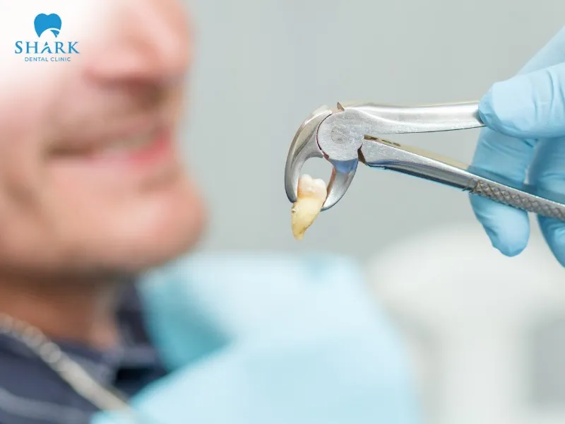 A dentist can extract a tooth even after root canal treatment if the tooth is chipped, causing numbness, pain, or discomfort