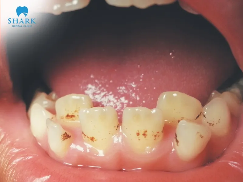 A black tooth after root canal may result from residual pulp tissue, changes in dentin, and other underlying causes