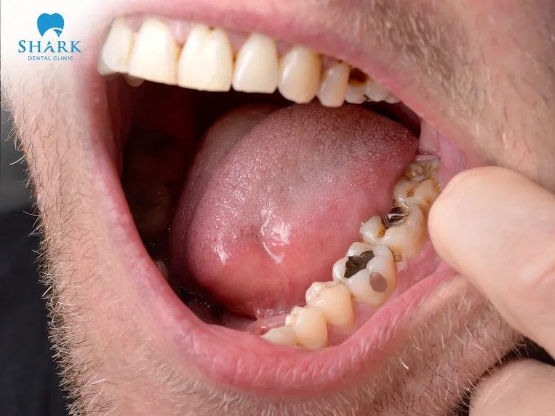 A black tooth after root canal not only affects aesthetics but also increases the risk of reinfection in the mouth