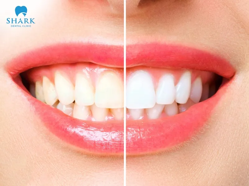 A black tooth after root canal can be corrected with professional teeth whitening at the dental clinic