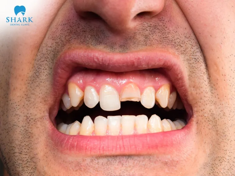 A broken root canal tooth is considered an emergency and requires immediate treatment to prevent serious complications