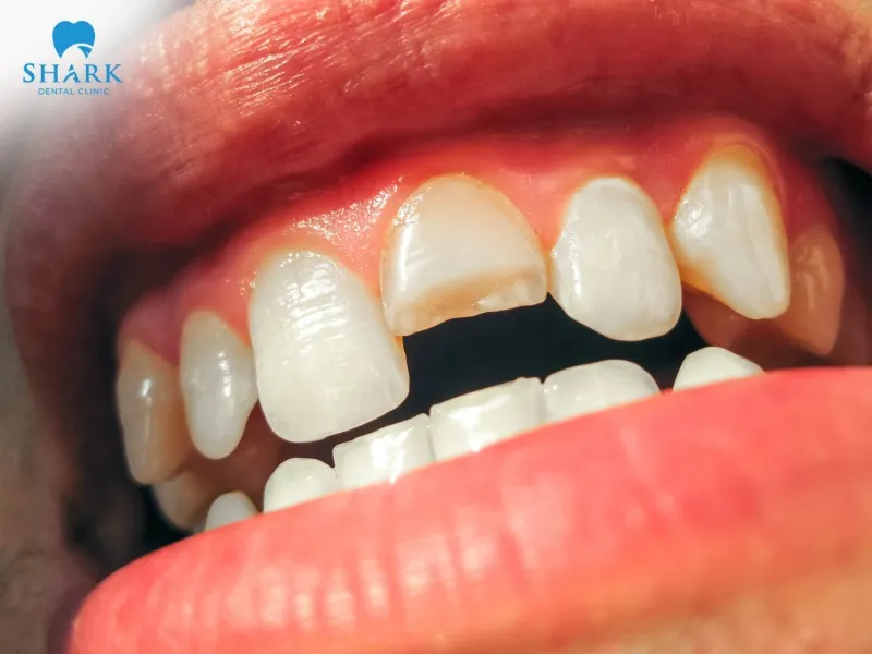 If a tooth breaks after a root canal and is not treated promptly, it increases the risk of reinfection, aesthetic issues, and reduced chewing ability