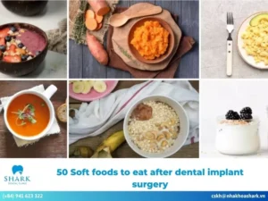 50 soft foods to eat after dental implant surgery