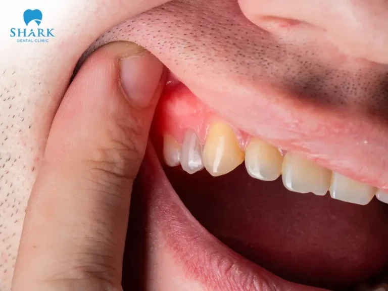 Gum recession and inflammation are signs that a dental implant may be loosening