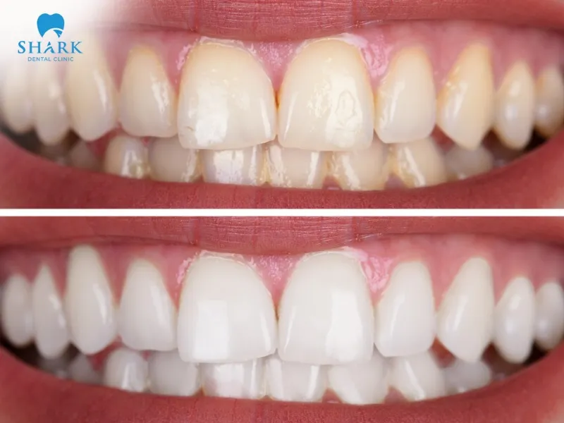 After root canal treatment at the dental clinic, many patients experience tooth discoloration, yellowing, and reduced aesthetics