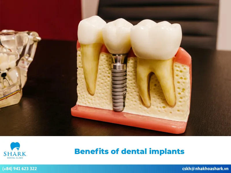Benefits of dental implants