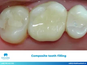 Composite tooth filling