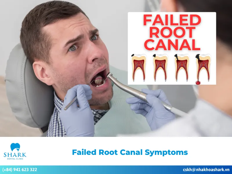 Failed root canal symptoms