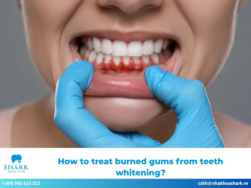 How to treat burned gums from teeth whitening