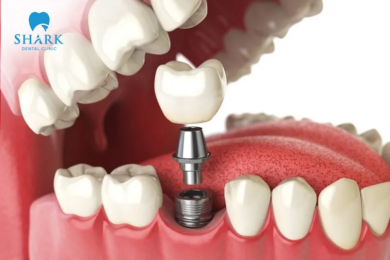 Implant placement is a safe method of tooth restoration, offering numerous advantages