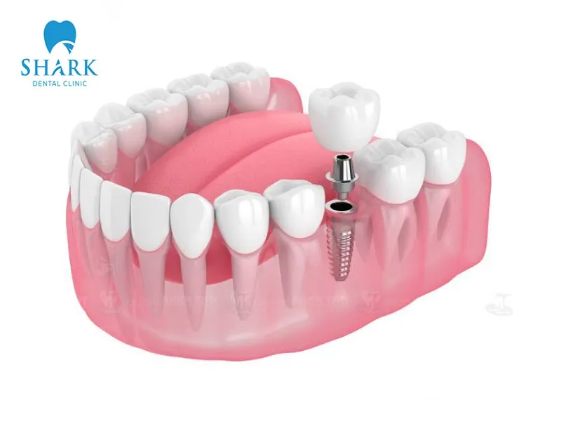 Dental implants prevent bone loss and minimize related complications