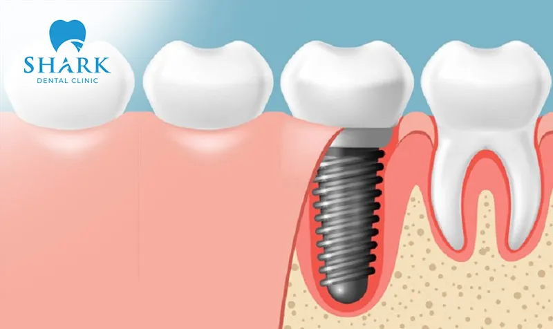Restored implant teeth ensure stable chewing function
