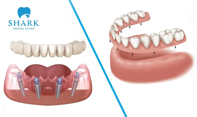 The dental implant method is safer and more effective compared to removable dentures