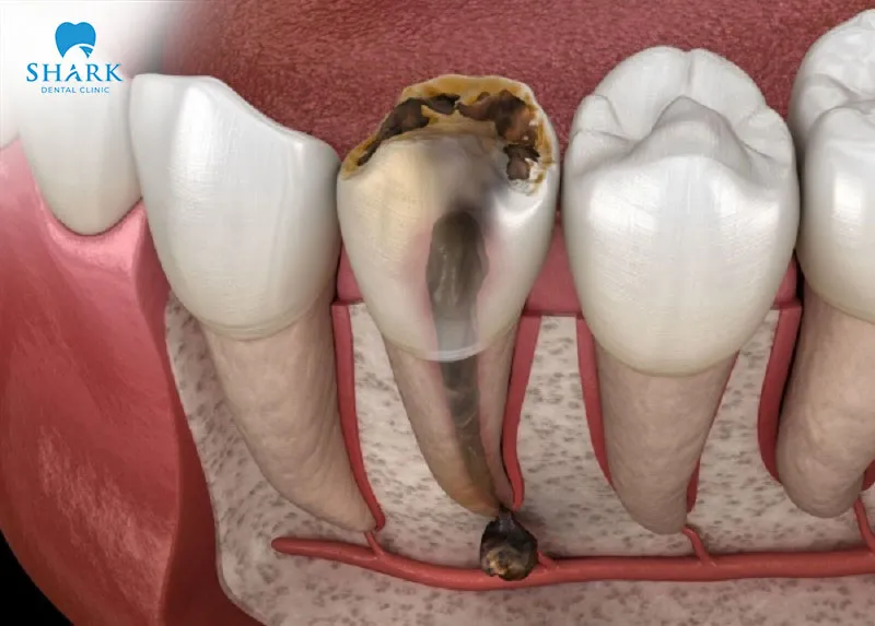 A calcified pulp can negatively affect your oral health