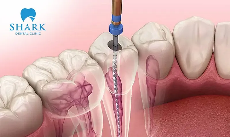 A calcified root canal can be caused by various factors such as tooth decay, trauma, or aging