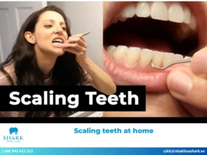 scaling teeth at home