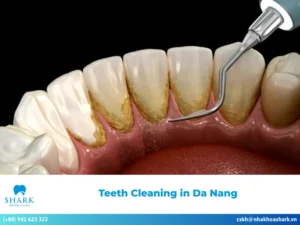 Teeth Cleaning in Da Nang