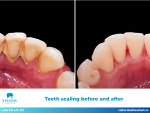 Teeth scaling before and after