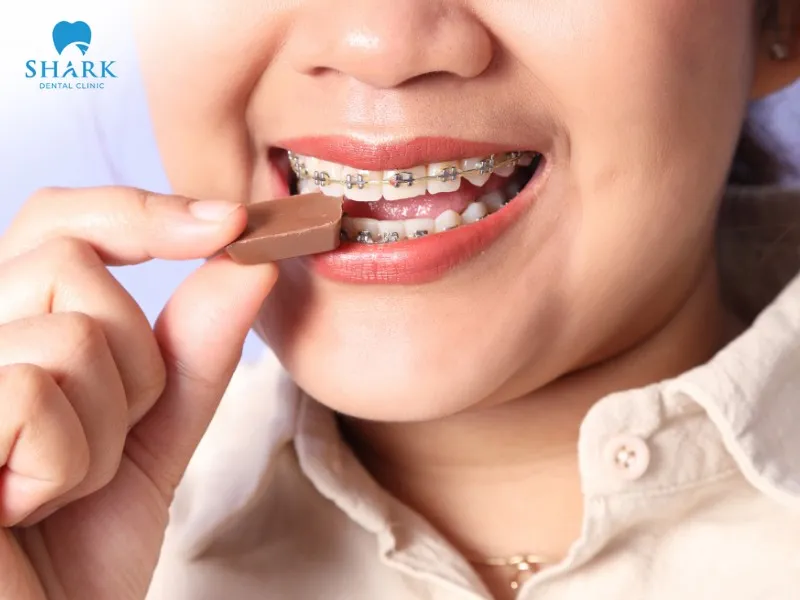 Eating excessive chocolate while wearing braces increases the risk of cavities and can affect the aesthetic results of orthodontic treatment