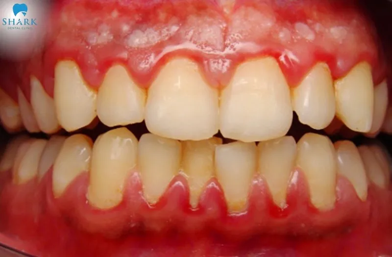 When gums are irritated by teeth whitening, the surrounding gum tissue may show white spots due to the effect of peroxide