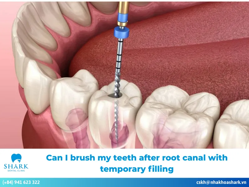 can i brush my teeth after root canal with temporary filling