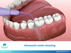 ultrasonic teeth cleaning