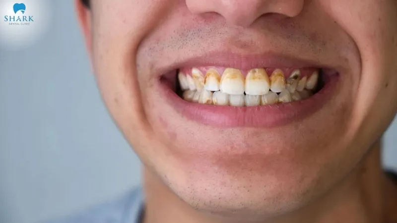 The acids in alcohol create a favorable environment for bacteria, quickly leading to the reformation of tartar