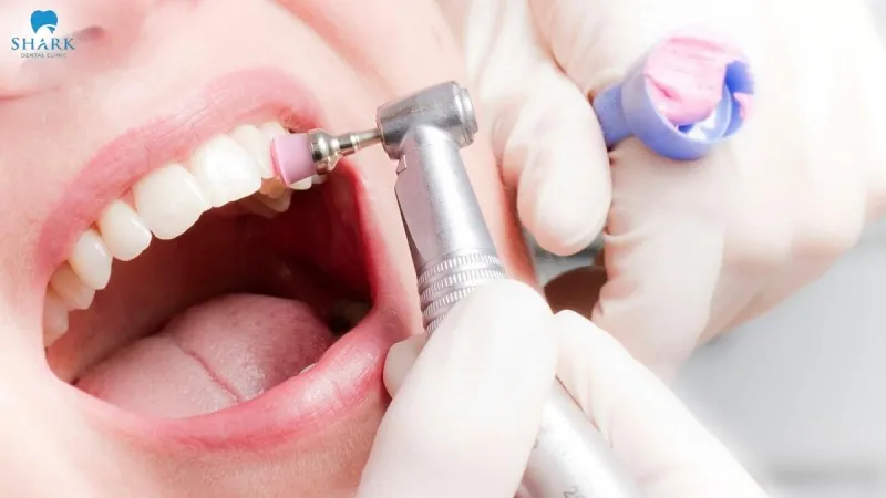 After the tartar has been removed, the dentist will polish the surface of your teeth using a special polishing paste and brush, helping to make the teeth smoother