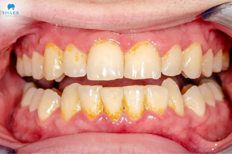 Before teeth scaling, visible tartar buildup is often seen along the gum line and between the teeth