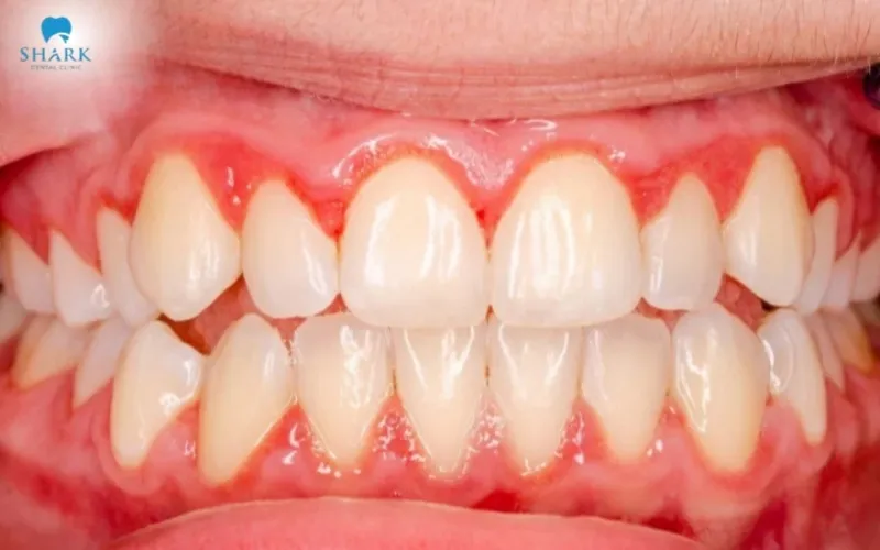 Once cleaned, teeth become visibly brighter with smoother surfaces