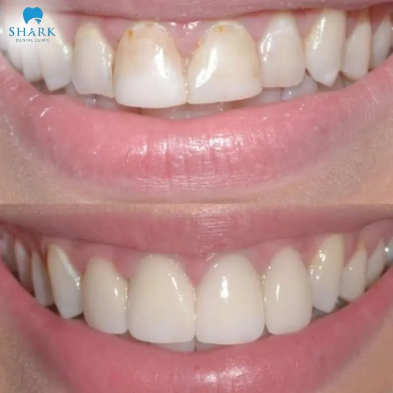After scaling, teeth appear whiter and more aesthetically pleasing