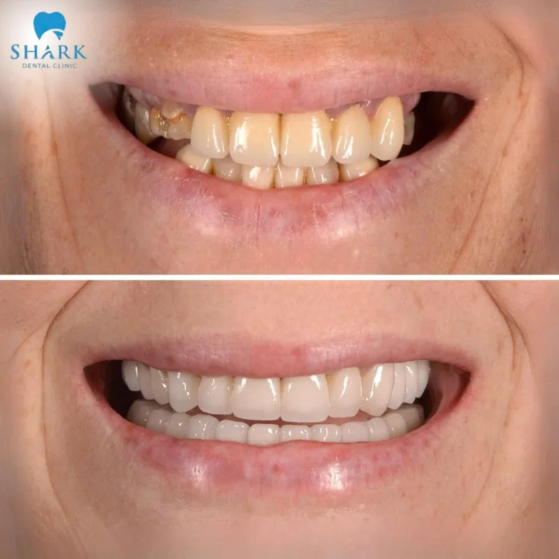 There is a noticeable difference between teeth scaling before and after images