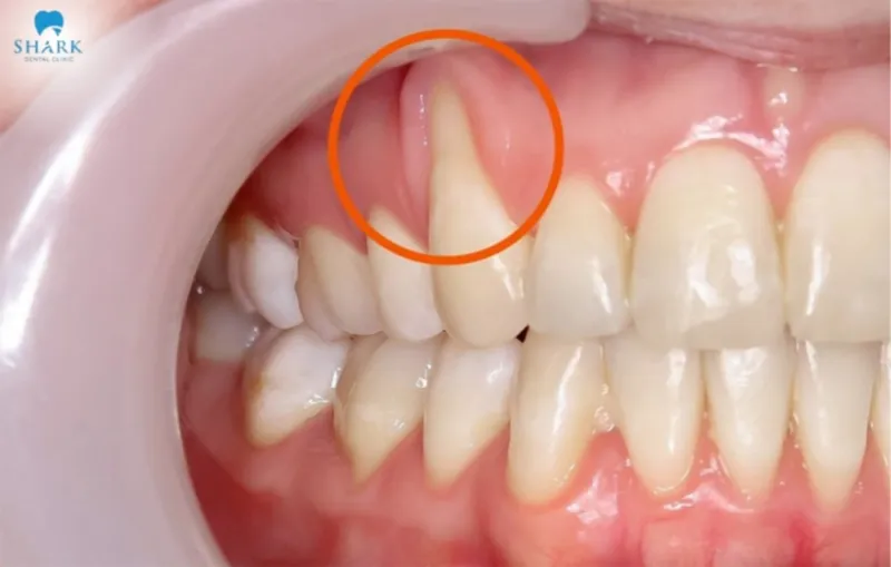 When gum recession occurs, you should visit a dental clinic for a deep cleaning to prevent bacteria from getting trapped between the gum line and teeth, which could lead to further infection