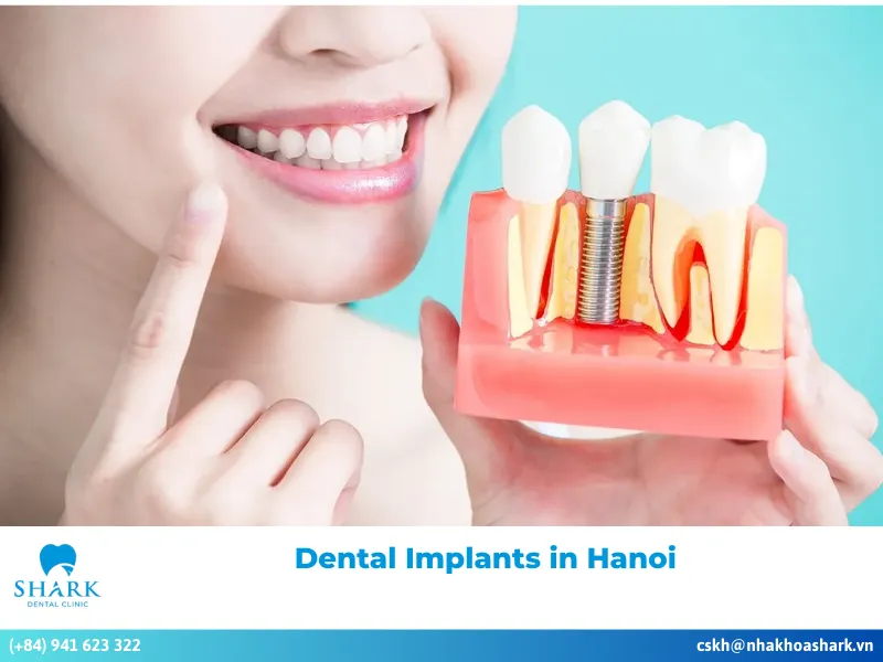 Dental Implants in Hanoi