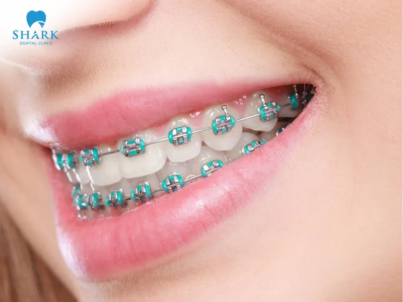 People who have had braces are at a higher risk of developing white spots on their teeth after whitening