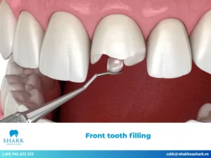 front tooth filling
