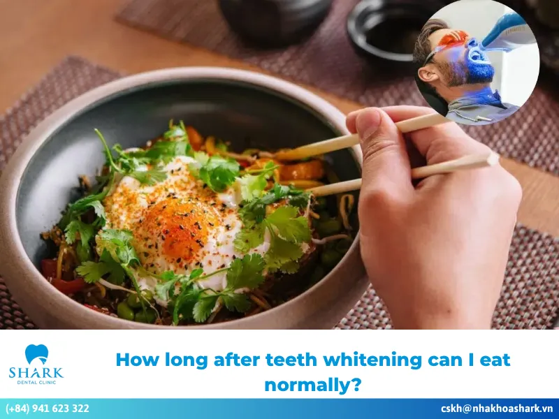 How long after teeth whitening can I eat normally?