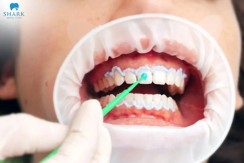Whether teeth whitening damages enamel also depends on the concentration of the bleaching agent used during the procedure