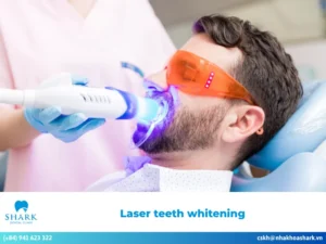 laser teeth whitening