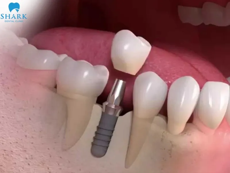 Straumann Implant (Switzerland) – the best restorative solution for cases of tooth loss