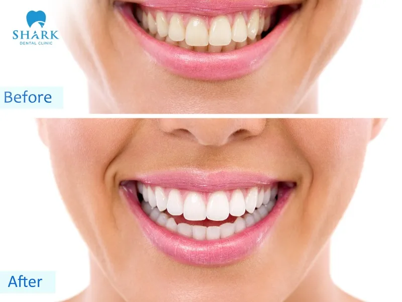 The results of teeth whitening can last from about 4 months to 3 years, depending on the method used
