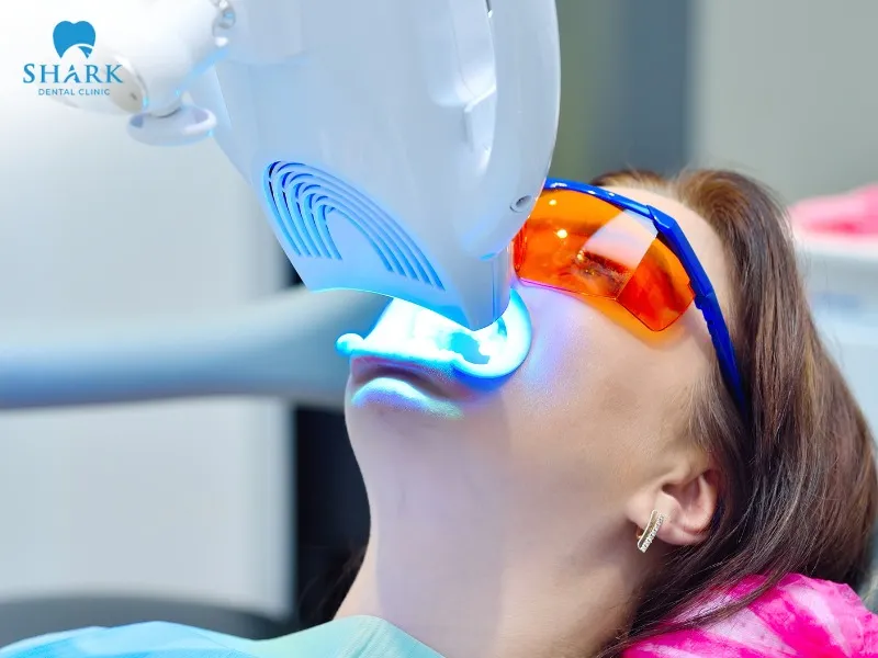 Laser teeth whitening uses a bleaching gel combined with laser light to generate heat, breaking down stains and plaque on the surface of the teeth