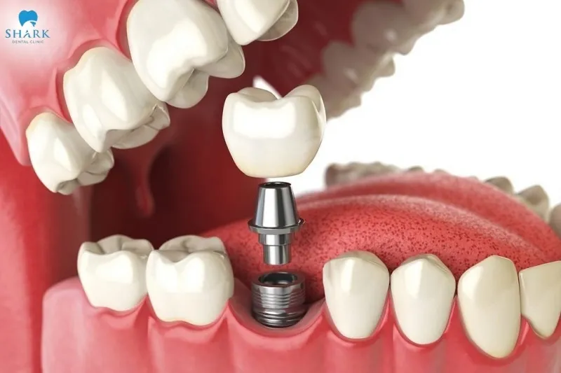Dental implants are considered the most advanced missing teeth replacement method available today