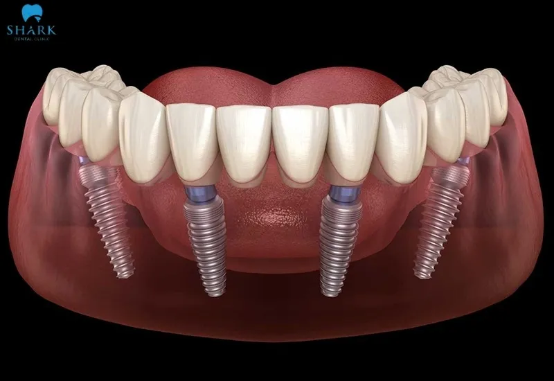 All-on-4 dental implants are a missing teeth replacement solution that optimally restores both chewing function and dental aesthetics