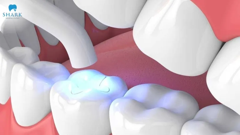 Composite tooth filling uses material to fill in imperfections or cavities in the teeth, thereby improving both chewing function and appearance