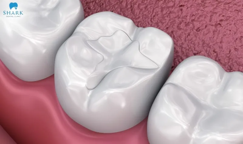 In addition to , porcelain fillings also offer many advantages, particularly their high aesthetic value