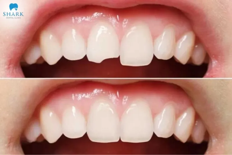 Composite is one of the most suitable materials for front tooth fillings